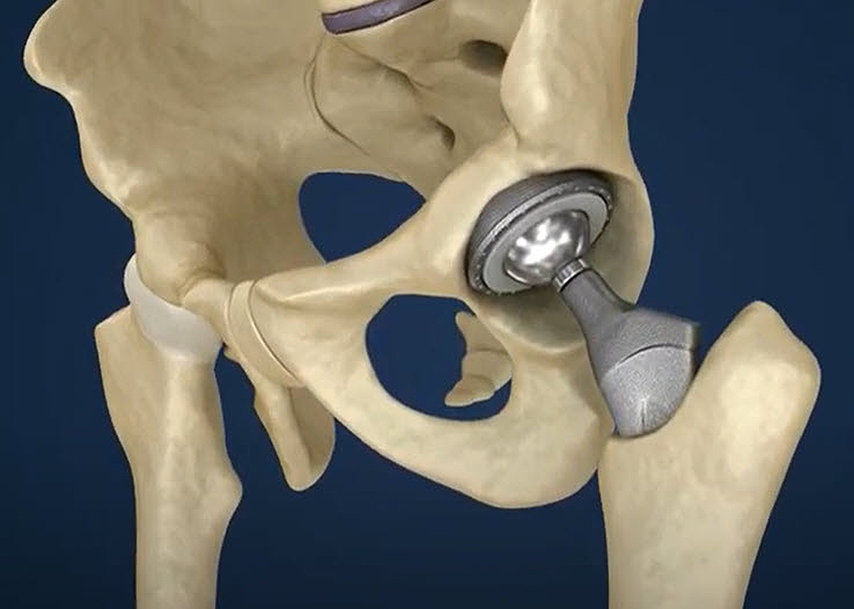 On the Ball with Hip Implants 